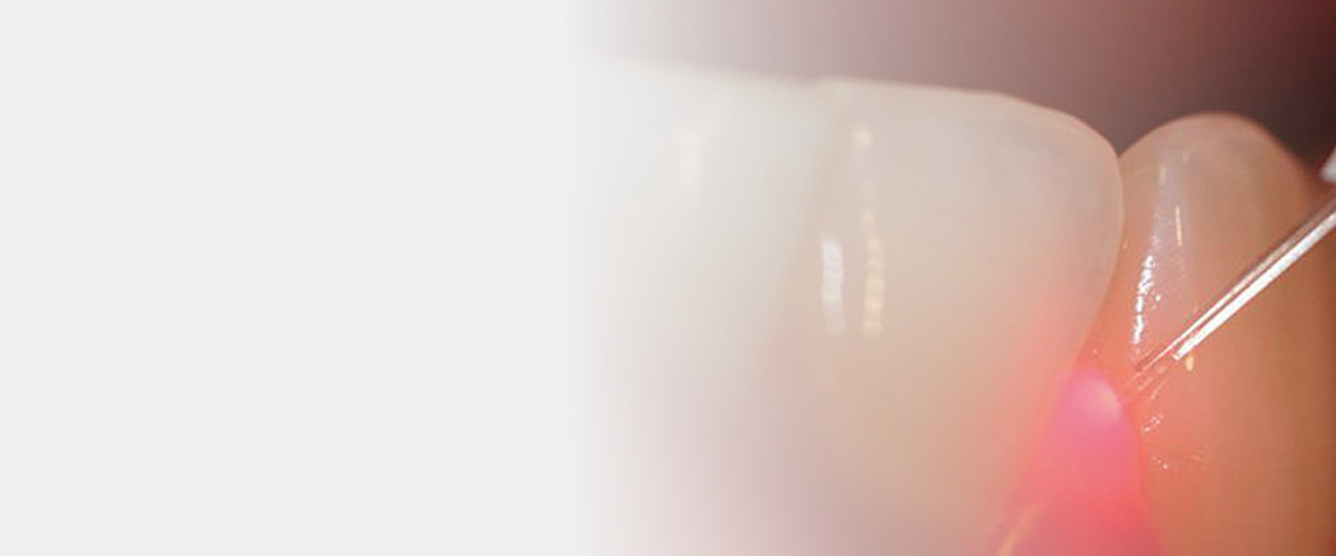 Laser Dentistry Hill Dentistry