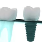 dental_implants_Grants_Pass_dentist